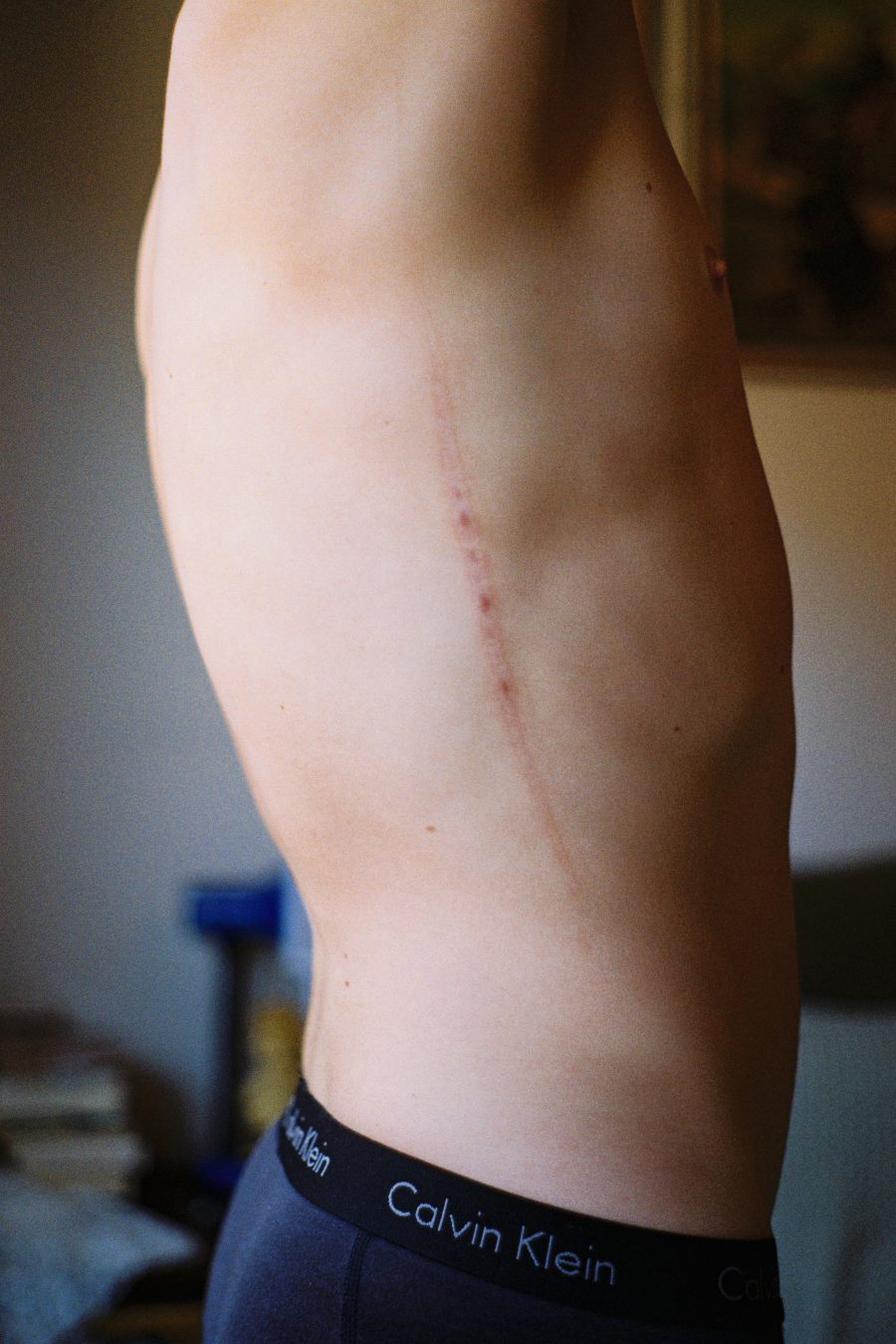 Scar on a person's torso.